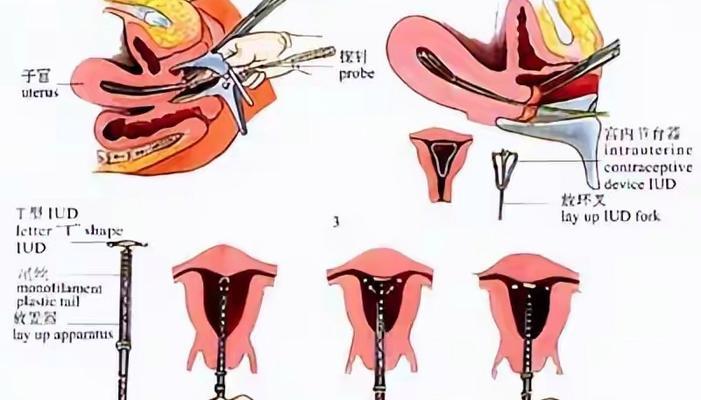 手术手环怎么解下来？解下来时需要注意什么？